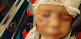 3-latek pogryziony przez psa w centrum miasta